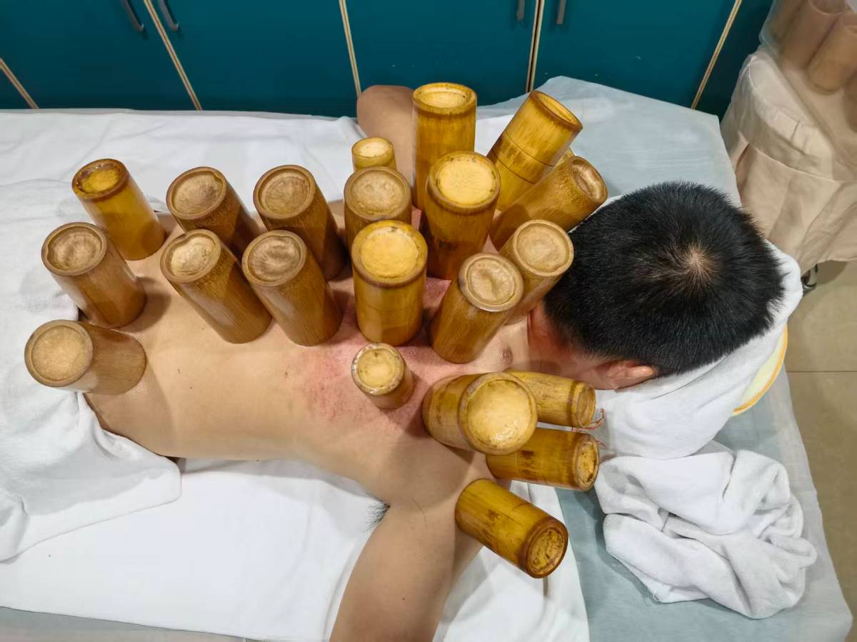 为治“昏沉困”去拔罐，结果：罐印留了，困意半点没走